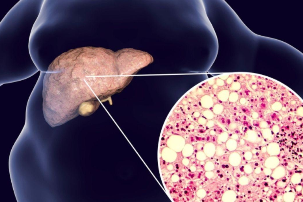 Esteatosis hépatica síntomas y tratamiento 